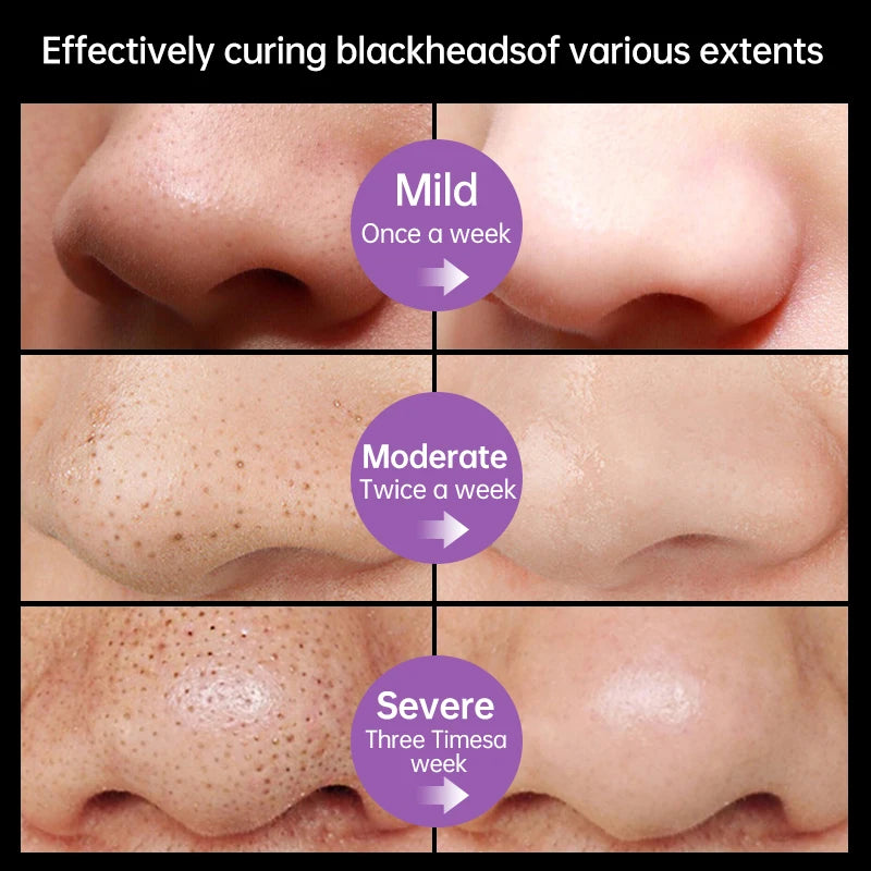 Blackhead Remover Nose Face Mask